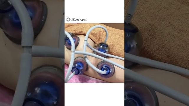 Массаж по технологии STRETCHING CELLULAIRE на ОРИГИНАЛЬНОМ оборудовании от Starvac в Севастополе смотреть онлайн