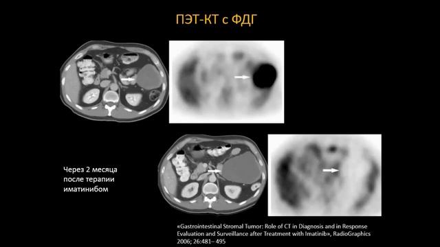 Ключникова Е.И. "Гастро-интестинальные стромальные опухоли» смотреть онлайн