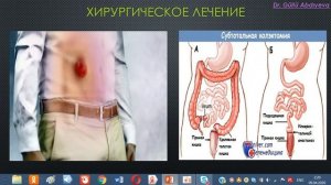 Хирургические болезни толстой кишки.