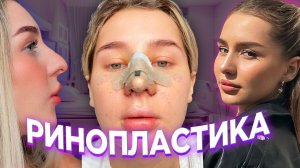 МОЯ РИНОПЛАСТИКА / Полная история