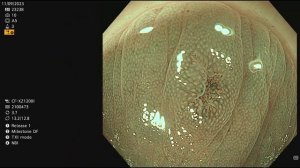 Colon Polyp: tubular adenoma with High grade during colonoscopy