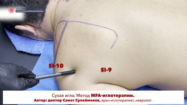 Сухая игла. Teres minor. МАЛАЯ КРУГЛАЯ МЫШЦА. Безопасная постановка иглы. смотреть онлайн