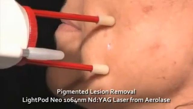 Лазерное удаление пигментных пятен и лазерное омоложение Friendlylight Era смотреть онлайн