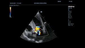 Субаортальный и аортальный  стеноз