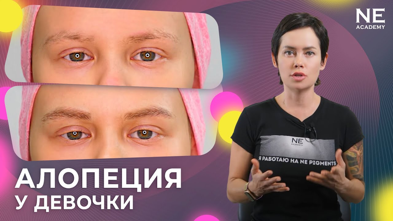 Алопеция у девочки. Волосковый татуаж бровей.