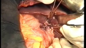 Родственная трансплантация печени, 2004