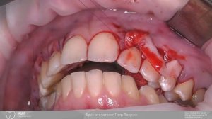 Закрытие рецессий