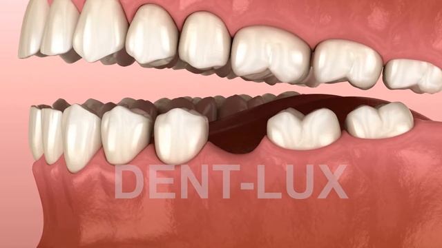 Что происходит после удаления зуба? смотреть онлайн