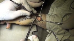 Рассечение 1 тыльного канала (компартмента) предплечья при болезни Де Кервена