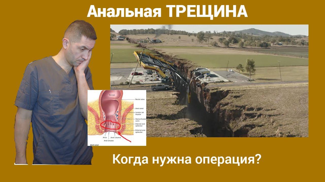 Анальная трещина. Когда нужна операция?