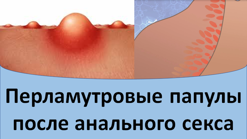 Перламутровые папулы после анального секса