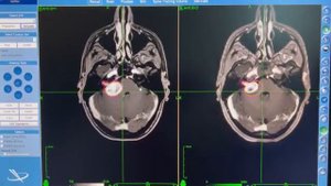 Невринома слухового нерва