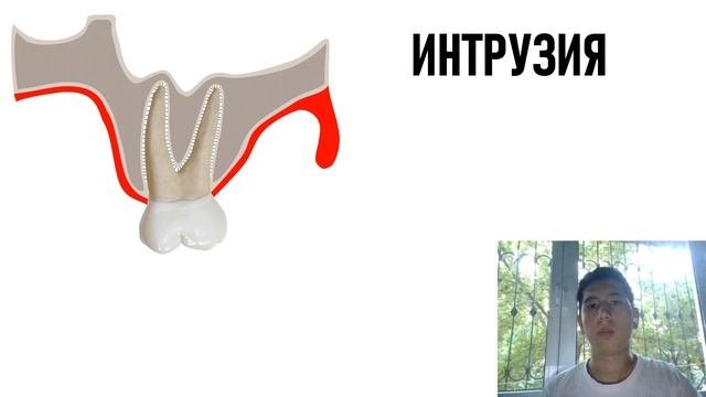 ЭКСТРУЗИЯ И ЭКСТРАКЦИЯ | ИНТРУЗИЯ И ВКОЛАЧИВАНИЕ | ОРТОДОНТИЯ