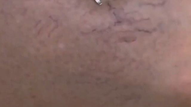 Удаление сосудов на лице и теле в Калуге смотреть онлайн