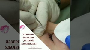Лазерное удаление детской гемангиомы