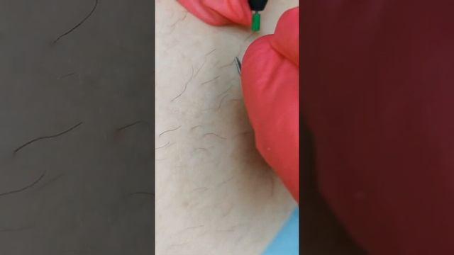 Как правильно делать электроэпиляцию