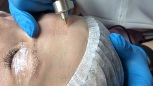 Плазменное омоложение , разглаживание морщин.