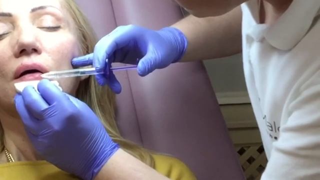Увеличение губ Lip augmentation Контурная пластика губ Malevych смотреть онлайн