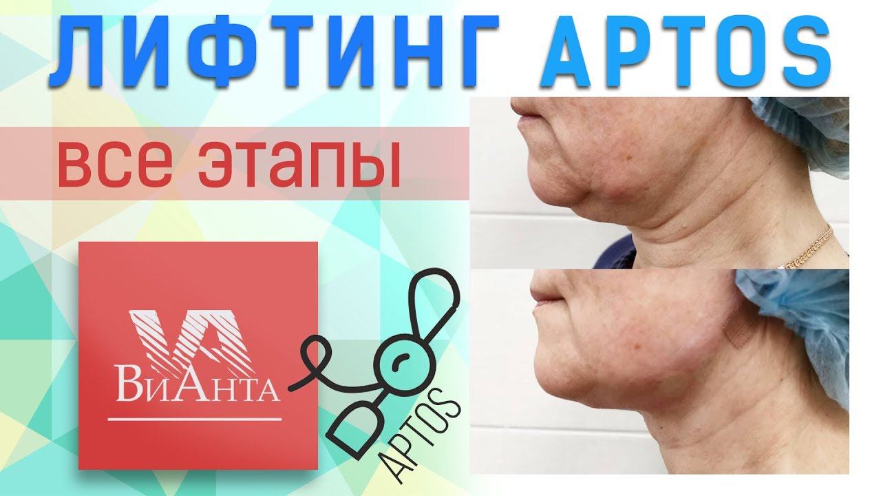 Лифтинг подбородочной области нитями APTOS