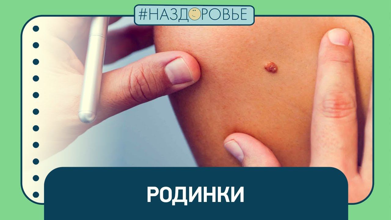 #НАЗДОРОВЬЕ: родинки