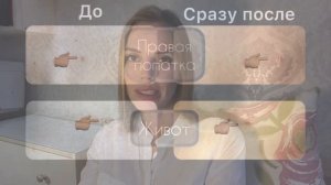 Лазерное удаление папиллом на теле. Процесс и результат через 7 месяцев