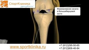 Повреждение передней крестообразной связки, ПКС