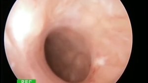vaginoscopy pin hole cervix