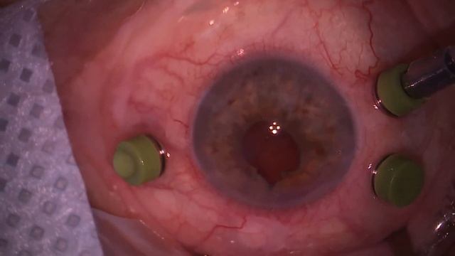 Реконструкция переднего и заднего отрезков глаза смотреть онлайн