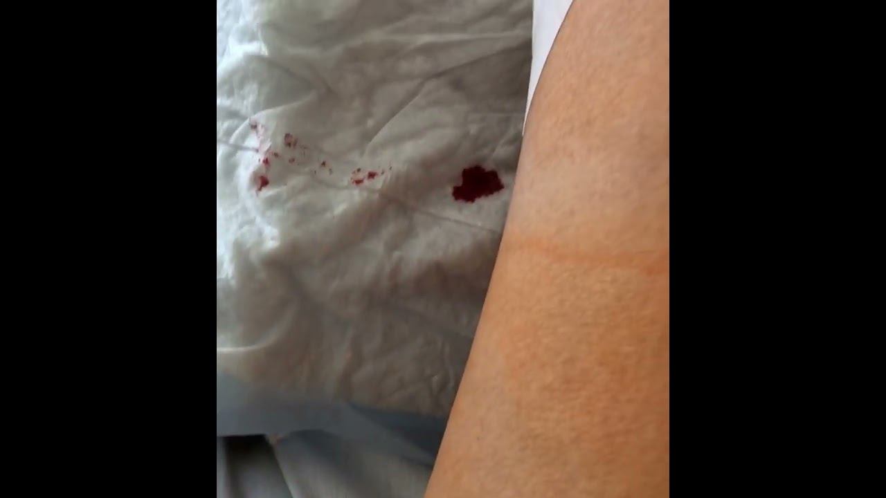 arthroscopy. Артроскопия