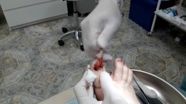 Удаление ногтя после травмы смотреть онлайн