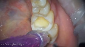 Подготовка зубов под керамические вкладки . Керамические вкладки , лечение зубов , виниры , коронки