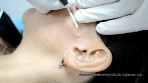 Невус смешанный, удаление методом радиоволновой хирургии