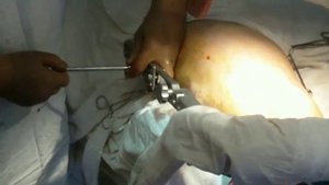 Интрамедуллярный штифт бедренной кости дистальный доступ.Intramedullar osteosintezi.استئوسنتز داБИО