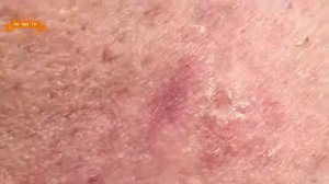 Удаление прыщей с носа и щек Spa G #94