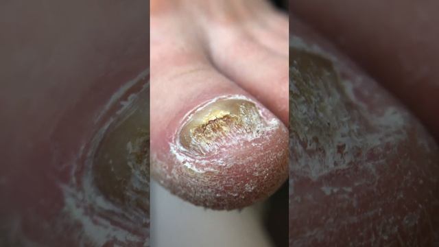 МАКРО | ГРИБОК НОГТЕЙ | MEDPED
