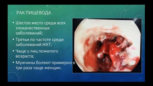 Заболевания пищевода