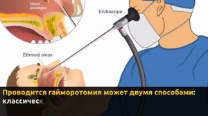 Гайморотомия