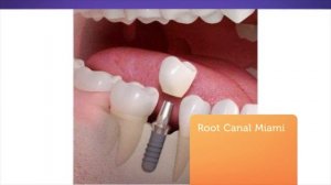 Root Canal Treatment At Apple Dental Group in Miami