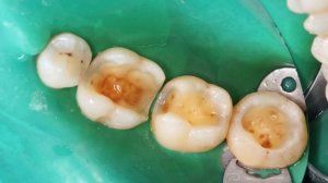 До и после: замена старых пломб и  восстановление зубов