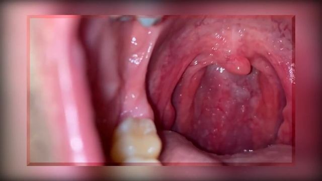 What are Tonsil stones? смотреть онлайн