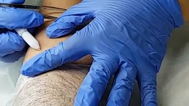 Электроэпиляция... Светлана Яковенко смотреть онлайн