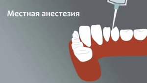 Шинирование зубов