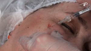 Мастер-класс по контурной пластике. Куда направлять срез канюли?