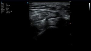 ultrasound knee injection пункция коленного сустава под узи контролем