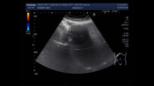 Hepatic Hydatid Cyst.