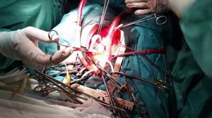 Резекция гигантской аневризмы левого желудочка сердца с тромбэктомией