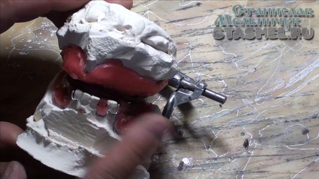 ЗУБНЫЕ ПРОТЕЗЫ. Перекрёстный прикус на съёмных зубных протезах смотреть онлайн