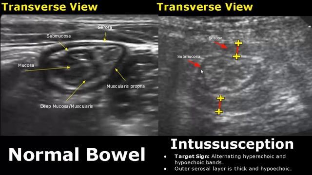 Small Bowel Ultrasound Normal Vs Abnormal Image Appearances | Gastrointestinal Tract (GIT) USG смотреть онлайн