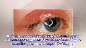 Что делать, если на глазу вскочил ячмень