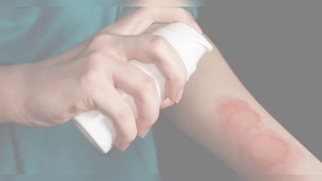 Күйік шалса тез көріңіз. Күйік шалған жерді тез басады. Күйген кезде не істеу керек. Ожога.